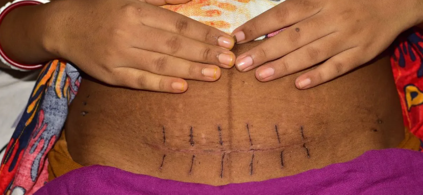 Jinsi ya kutunza kidonda baada ya kujifungua kwa upasuaji – caesarean section